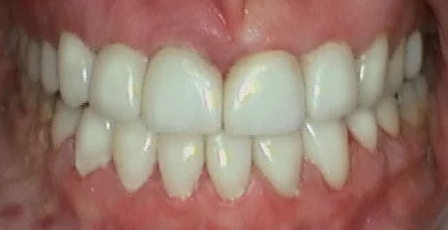 Case 01 after — Porcelain Veneers