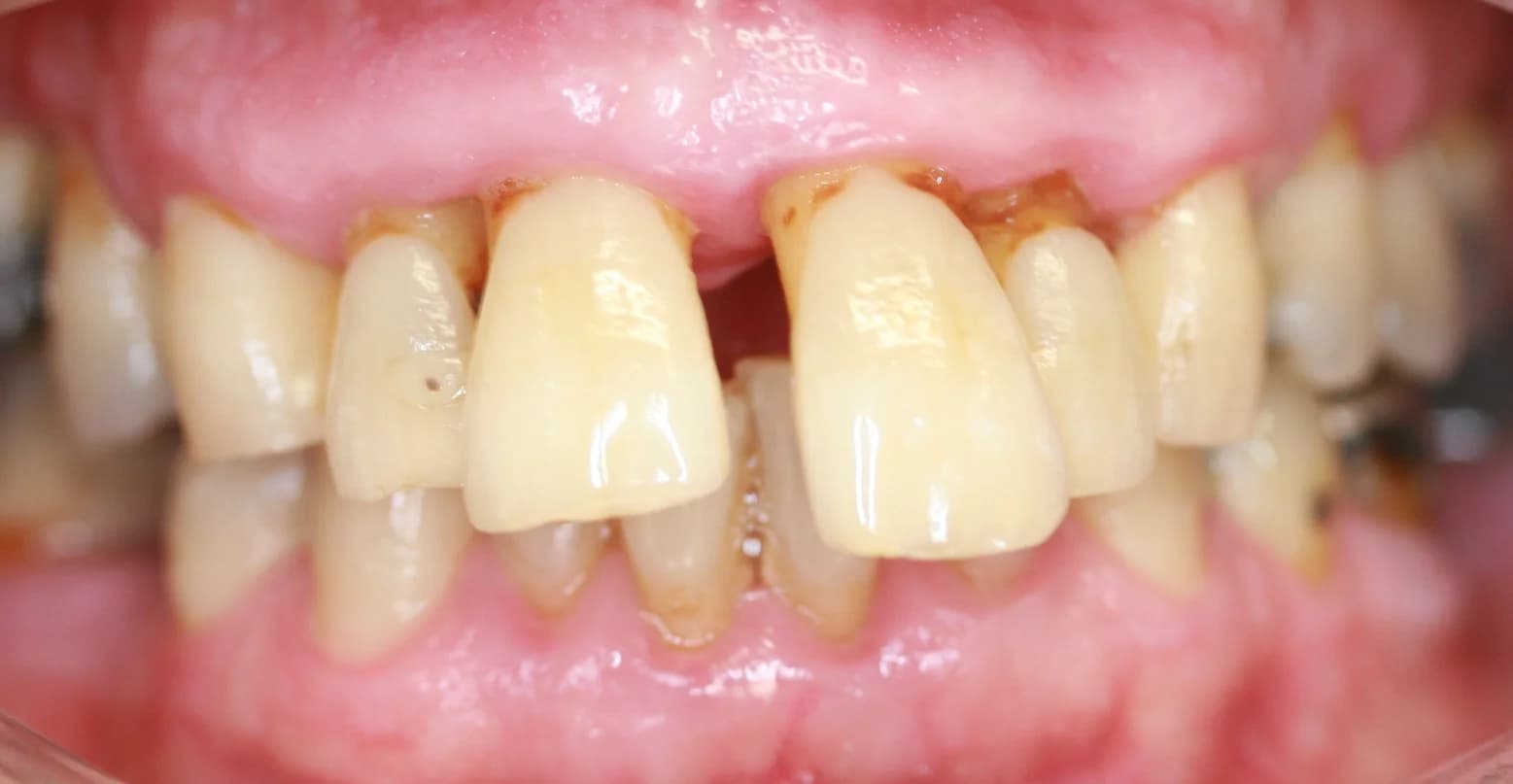 Case 02 before — Smile Makeover