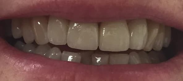 Case 04 after — Composite Bonding
