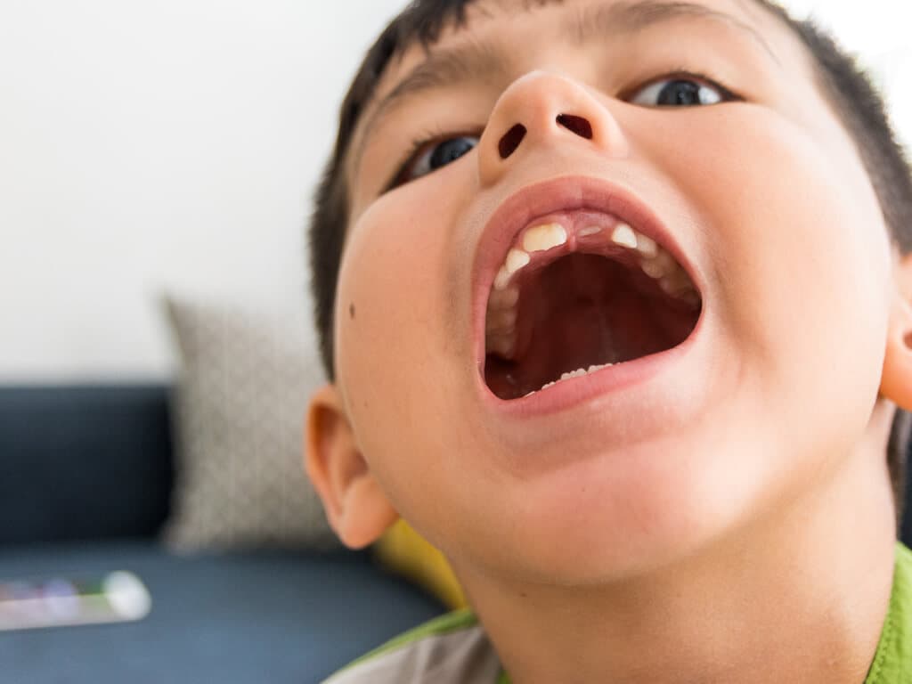 Why Are Space Maintainers Important for Children’s Dental Health?